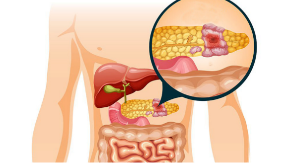 Modern Cancer Hospital Guangzhou, Solusi Pengobatan Kanker Pankreas Terbaik