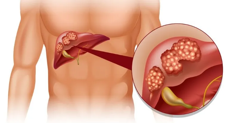 Penyebab, Gejala, dan Cara Mengobati Kanker Hati