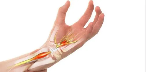 Sindrom Carpal Tunnel, Ketika Saraf Pergelangan Terganggu